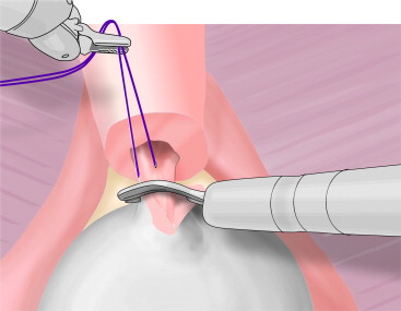 Robot Suturing Diagram
